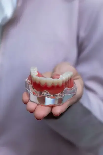 Modelo de prótesis dental sobre implantes, odontología CECP